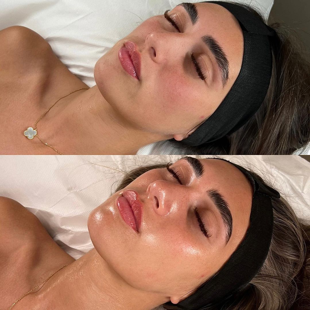HYDRAFACIAL PARIS